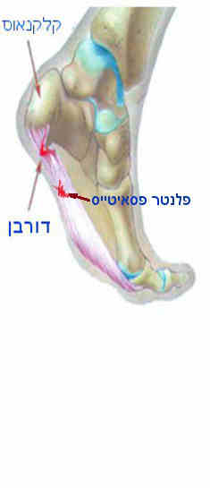 ציור המדגים קרע בפלנטר פסיה בחיבורה לעקב הקרוי גם דורבן בכף הרגל