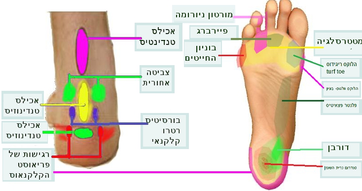 סוגי הכאבים בכף הרגל