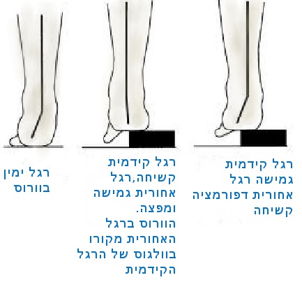 כף רגל בסופינציה מוגברת עם ובלי פיצוי של הפרק הטלו קרוראל