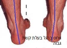 כף רגל , קרסול בקשת גבוה היפר סופינייטד