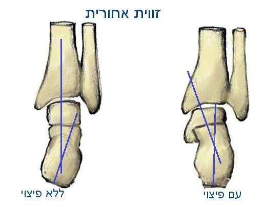 כף רגל בסופינציה מוגברת עם ובלי פיצוי של הפרק הטלו קרוראל