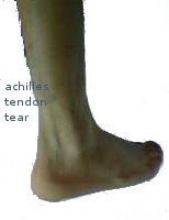 אכילס טנדינטיס, דלקת גיד אכילס כאבים בכף הרגל