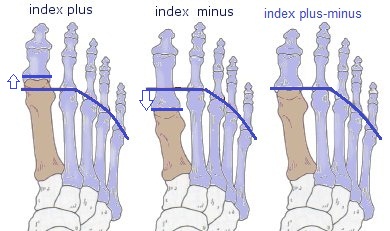 אנטומיית כף רגל - הלוקס וולגוס אינדקס פלוס
