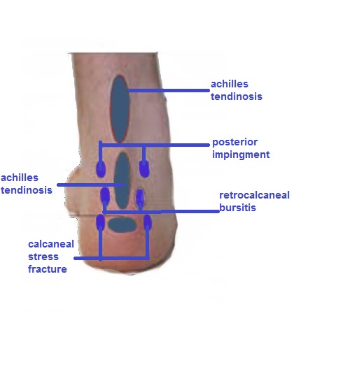 כף הרגל ונקודות הכאב בצביטה אחורית בכף הרגל, דלקת גיד אכילס, דלקת בורסה קלקנאוס, שברי מאמץ בקלקנאוס