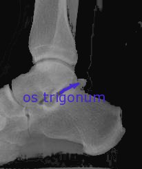 צילום רנטגן של הקרסול וזיהוי os trigonum 