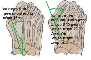 אנטומיית כף רגל - הלוקס וולגוס