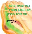 אנטומיית כף רגל - הלוקס וולגוס