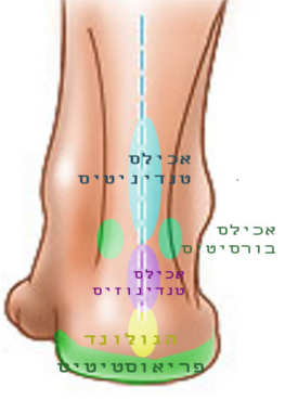   סוגי הכאבים בכף הרגל האחורית- מבט אחורי